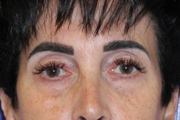 Before Fillers Female Patient Front Angle View Case 2871