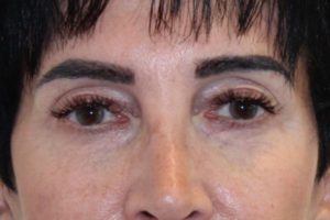 After Fillers Female Patient Front Angle View Case 2871