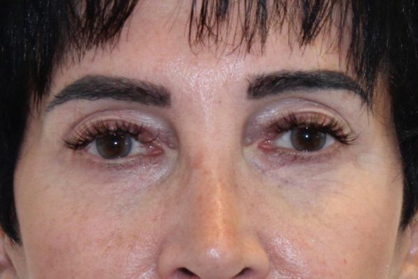 After Fillers Female Patient Front Angle View Case 2871