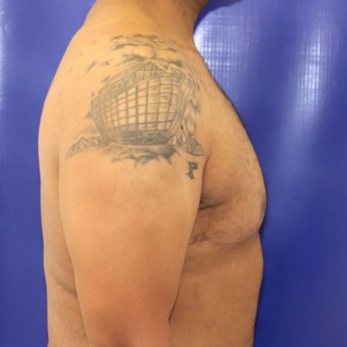 After Gynecomastia Male Patient Side Angle View Case 2886