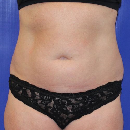 Before Halo Lift Case Female Patient Front Angle View 2893