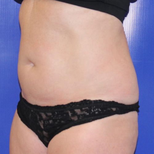 Before Halo Lift Female Patient Diagonal Angle View Case 2893