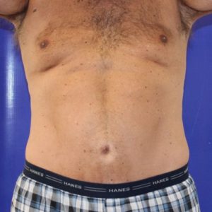 After Halo Lift Male Patient Front Angle View Case 2902