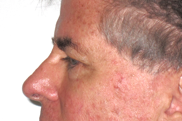 before blepharoplasty male patient side view case 3346