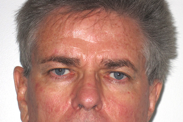 before blepharoplasty male patient front view case 3346