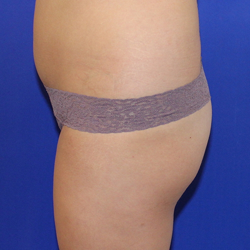 before brazilian butt lift side view case 3273