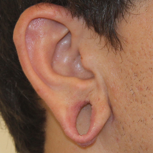 before stretched earlobe repair case 3209