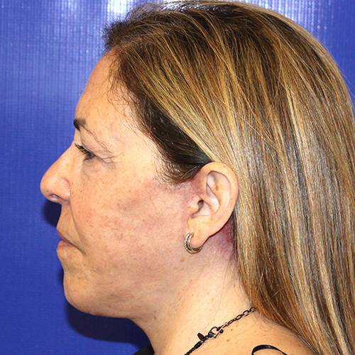 after face and neck lift female patient side view case 3294