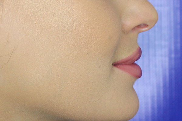 after filler female patient side view case 3305