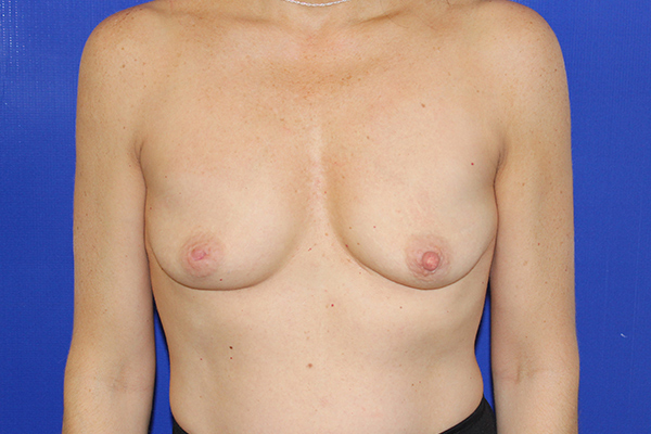 before inverted nipple repair case 3322 2