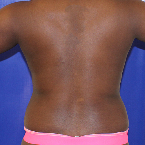 before liposuction back view case 3357