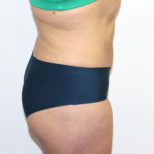 after liposuction stomach female patient side view case 3360