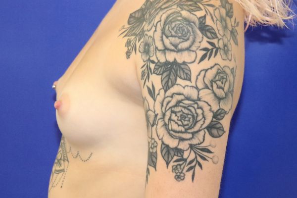 before breast augmentation left side female patient case 3567