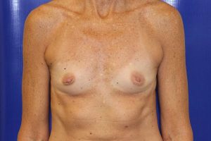 before breast augmentation front view female patient case 3574