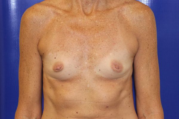 before breast augmentation front view female patient case 3574