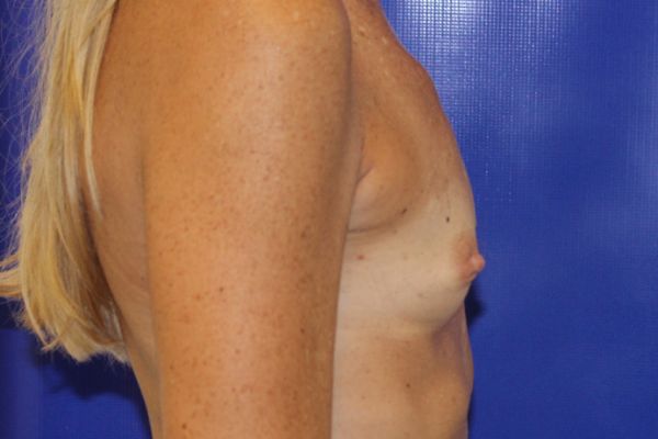 before breast augmentation right view female patient case 3574