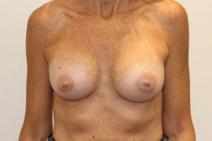 after breast augmentation front view female patient case 3574