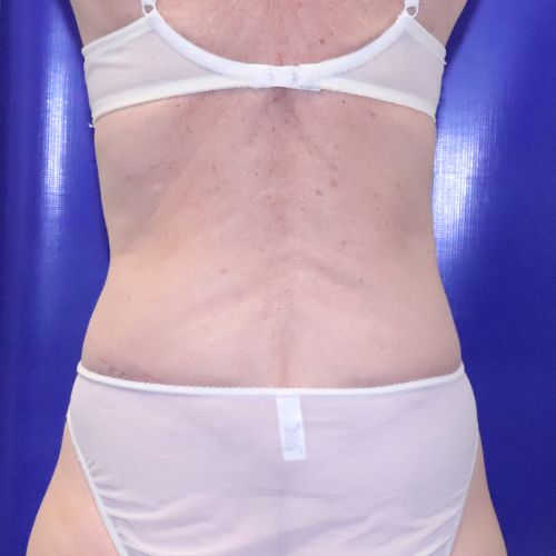 after halo lift back view female patient case 3582