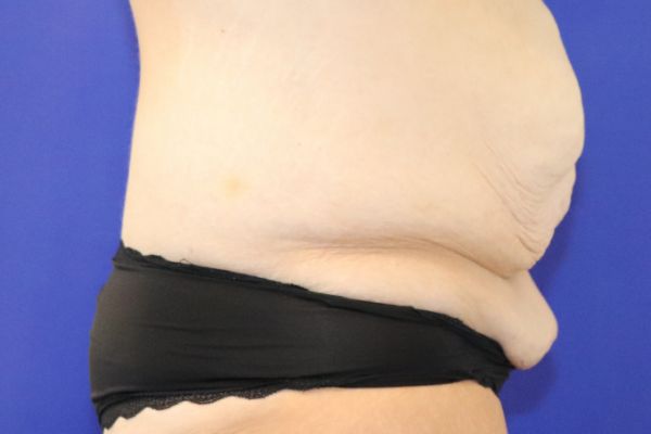 before circumferential abdominoplasty right view female patient case 3864