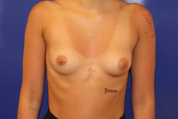 before breast augmentation front view female patient case 4522