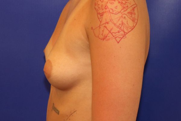 before breast augmentation left view female patient case 4522