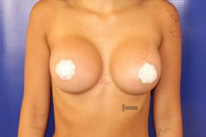 after breast augmentation front view female patient case 4522