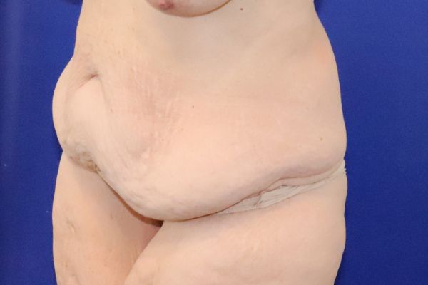 before circumferential abdominoplasty left angle view female patient case 4554