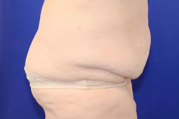 before circumferential abdominoplasty right view female patient case 4554