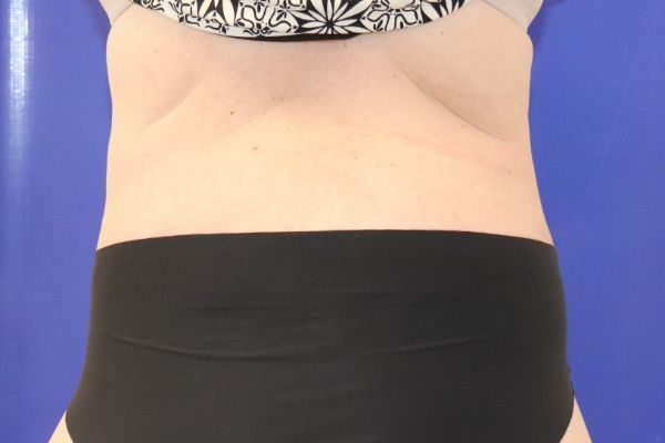 after circumferential abdominoplasty back view female patient case 4554