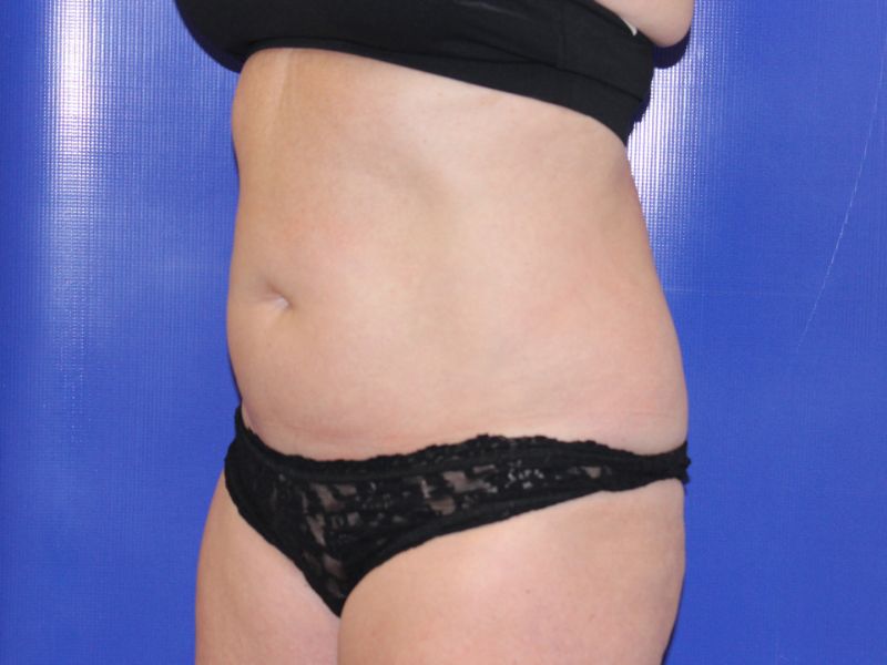 before halo lift left angle view female patient case 4538