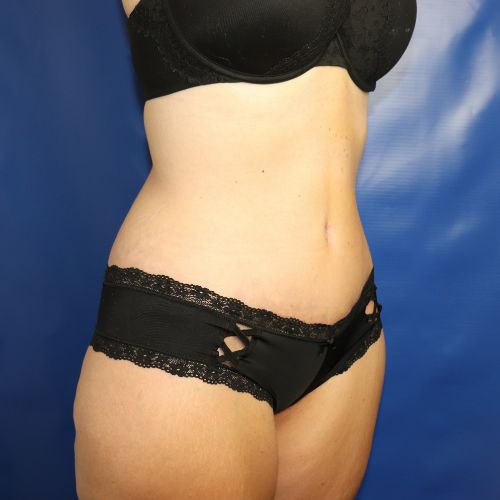 after halo lift right angle view female patient case 4545