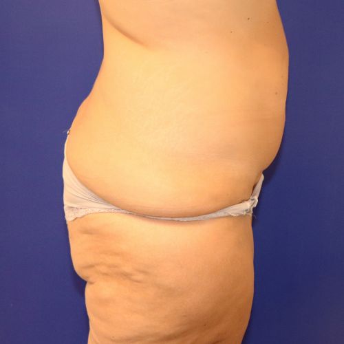 before halo lift right view female patient case 4545