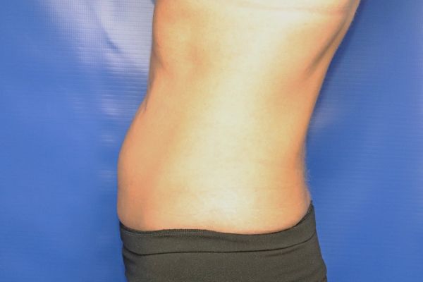 before cooltone left view female patient case 4612