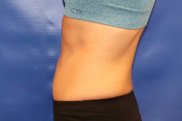 after cooltone left view female patient case 4612