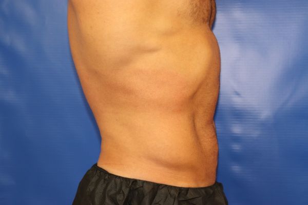 after cooltone right view male patient case 4621