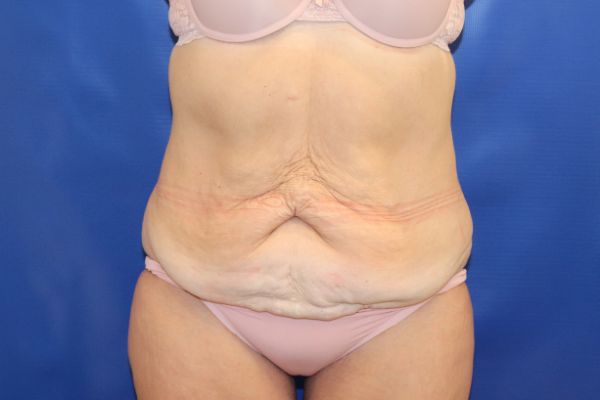 before circumferential abdominoplasty front view female patient case 4649