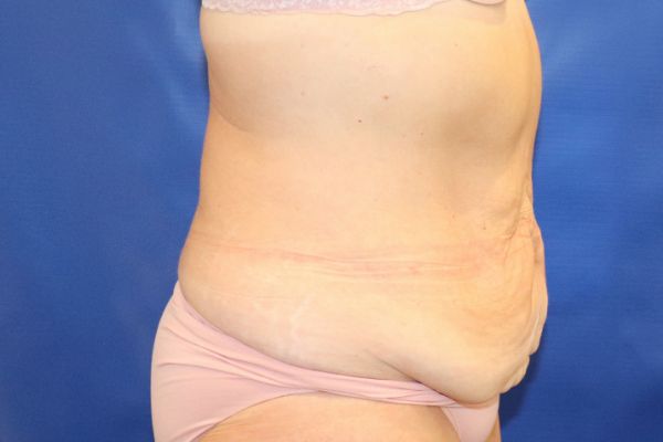 before circumferential abdominoplasty right view female patient case 4649
