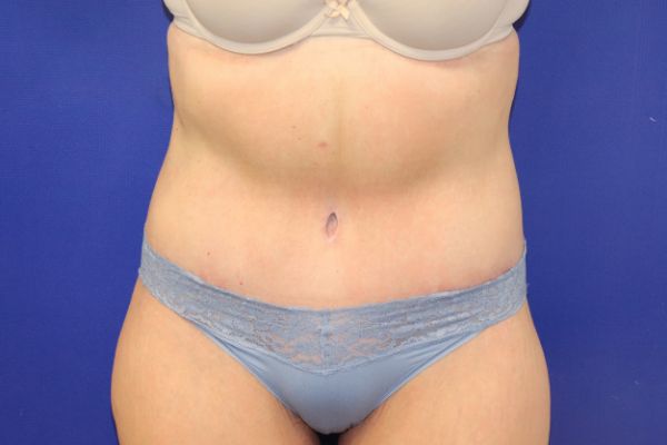 after circumferential abdominoplasty front view female patient case 4649