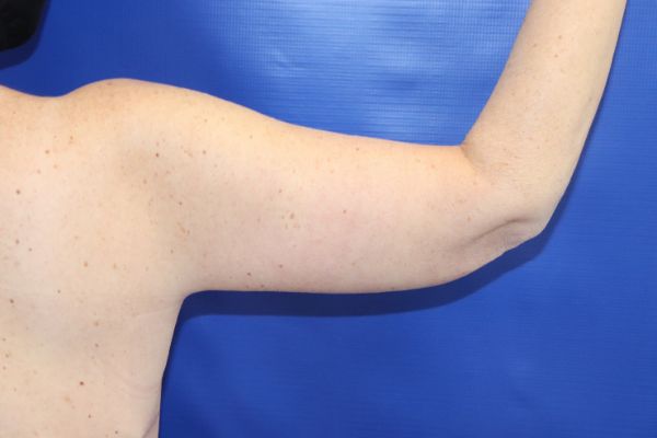 after arm lift back view female patient case 4712