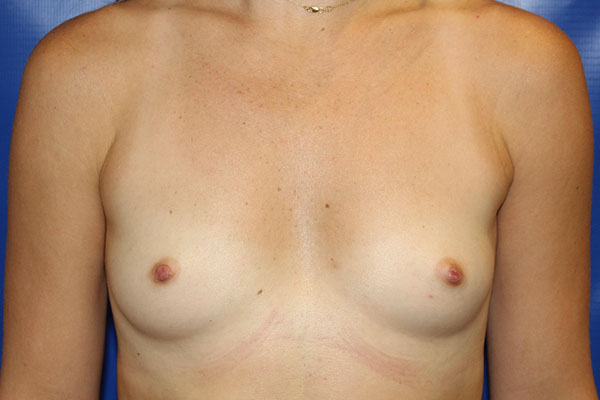 before breast augmentation front view female patient case 5392