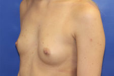 before breast augmentation left angle view female patient case 5405