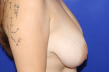 before breast reduction right view female patient case 5417