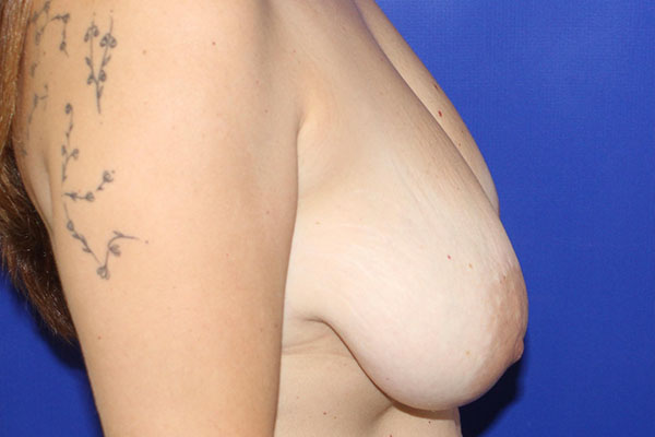 before breast reduction right view female patient case 5417