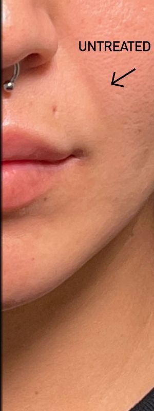 before filler closeup front view female patient case 5433