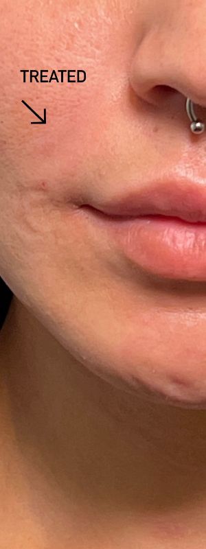 after filler closeup front view female patient case 5433