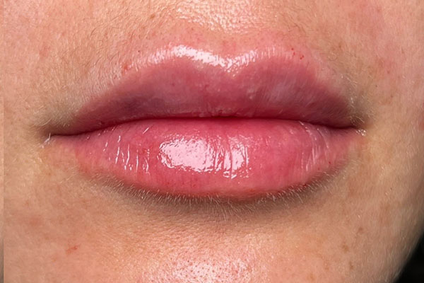 after filler closeup front view female patient case 5437