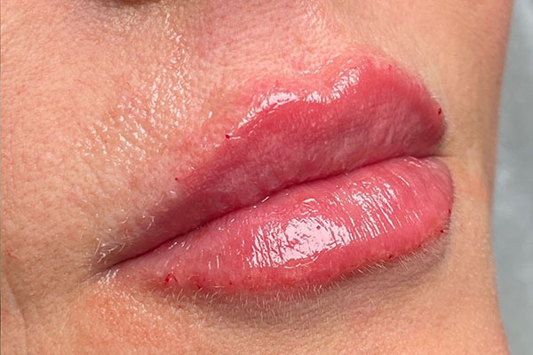 after filler closeup left view female patient case 5440