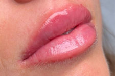 after filler closeup left view female patient case 5443