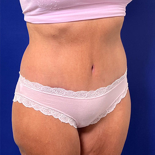 after halo lift right angle view female patient case 5453