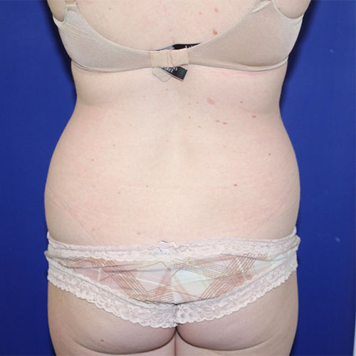 before halo lift back view female patient case 5458